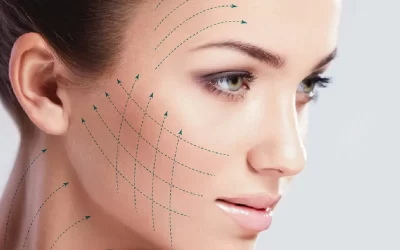 Hilos tensores en Sevilla: Tratamiento ideal contra la flacidez facial